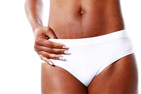 PRP for Stretch Marks