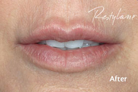 Female Restylane After Results
